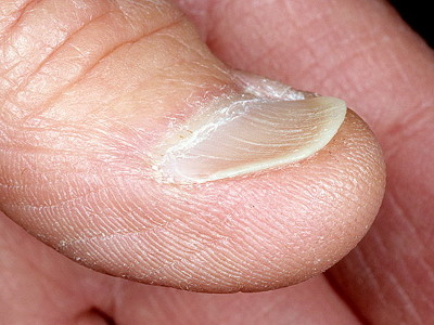 Как выглядят болезни по ногтям
