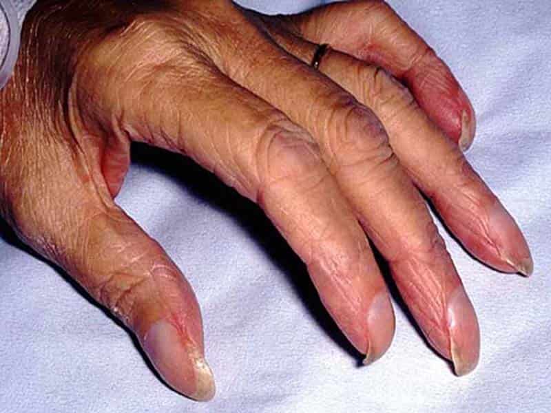 Редкие заболевания ногтей рук