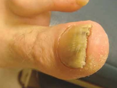 Онихогрифоз ногтей: начальная стадия