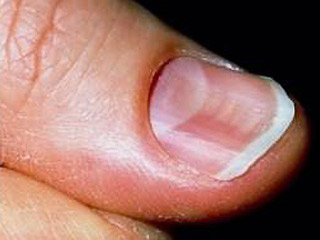 Деформация ногтевой пластины при койлонихии