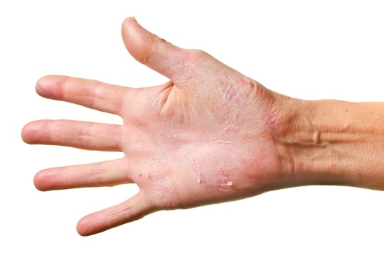 Особенности лечения грибка на руках