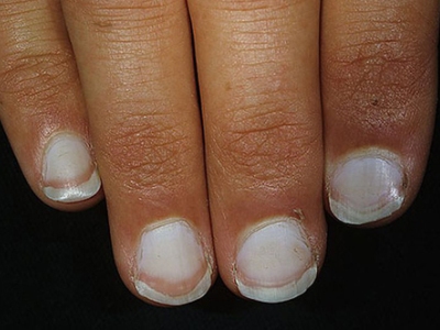 Признаки и лечение кандидоза ногтей