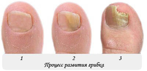 Что такое онихомикоз ногтей на руках и ногах