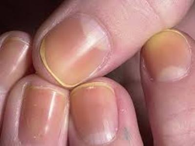 От чего желтеют ногти