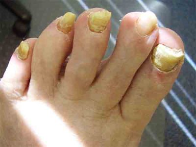 Ногти на ногах желтеют и утолщаются лечение