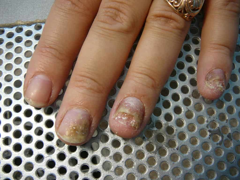 Как выглядит грибок ногтей