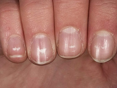 Белые полосы на ногтях рук
