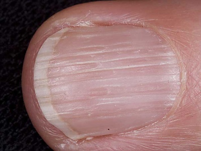 Белые полосы на ногтях рук