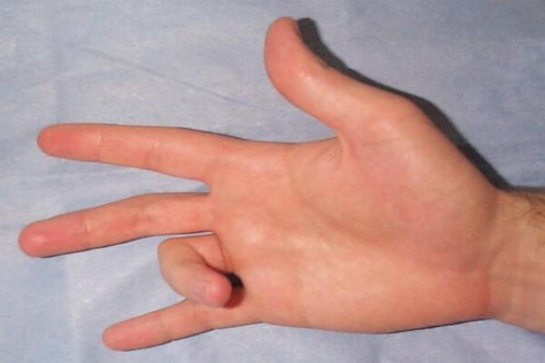 Тендовагинит пальцев