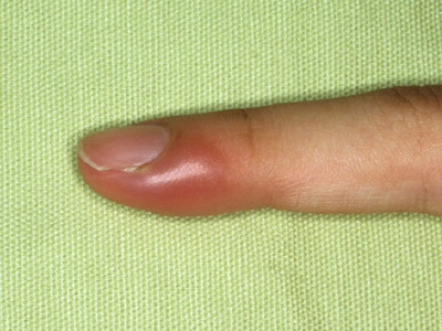 Острое воспаление пальца руки возле ногтя