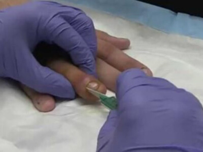 Лечение нарыва возле ногтя хирургическим путем