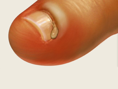 Опухоль на пальце руки возле ногтя