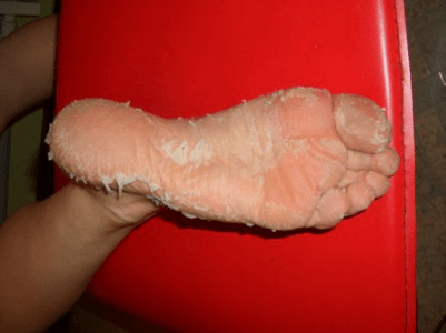 После использования носочков для педикюра кожа интенсивно облезает