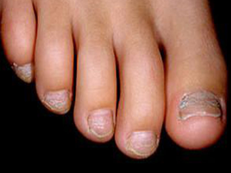 Как можно лечить псориаз на ногтях