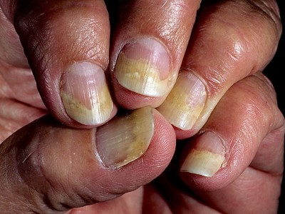Как лечить псориаз ногтей – признаки заболевания