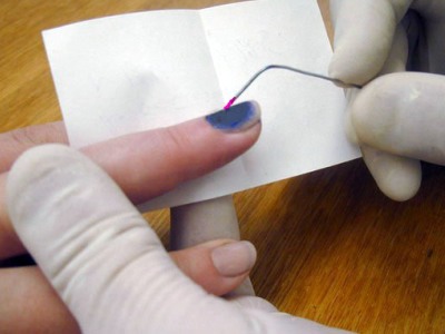 Ушиб ногтя на руке лечение