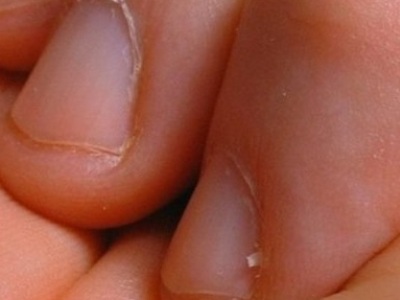 Как выглядят заусенцы на пальцах рук