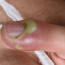 Нарыв на пальце возле ногтя: как лечить с помощью медикаментов