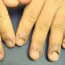 О чем «говорят» болезни ногтей на руках