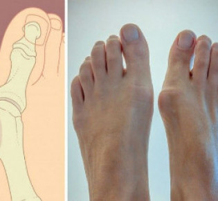 Как избавиться от косточки на ноге: основные методы лечения