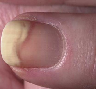 Отслойка ногтя от ногтевого ложа: симптоматика