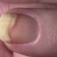 Отслойка ногтя от ногтевого ложа: симптоматика