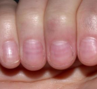 Полоски на ногтях: причины, разновидности и диагностика