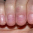Полоски на ногтях: причины, разновидности и диагностика