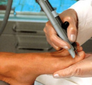 Лечение вросшего ногтя лазером: плюсы и минусы данного метода