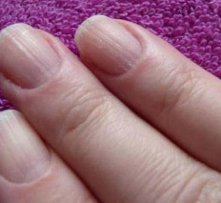 Почему ногти становятся ребристыми: причины и лечение