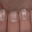 Возможные причины появления белых ногтей на руках