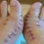 Удаление косточки на большом пальце ноги: операция как метод консервативного лечения