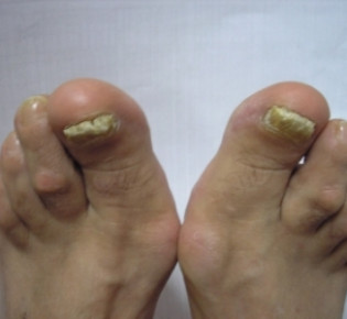 Утолщение ногтей на ногах: причины, диагностика