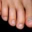 Как лечить псориаз, появившийся на ногтях