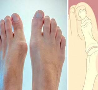 Шишка на большом пальце ноги: как лечить, причины и стадии заболевания, методы диагностики