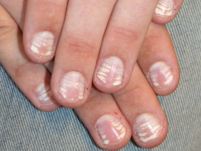 Белые полосы на ногтях
