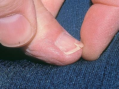Как вылечить трещину ногтя thumbnail