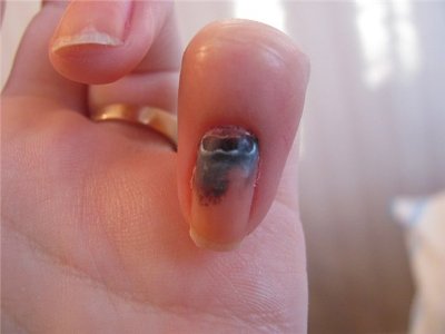 Как вылечить прибитые ногти thumbnail