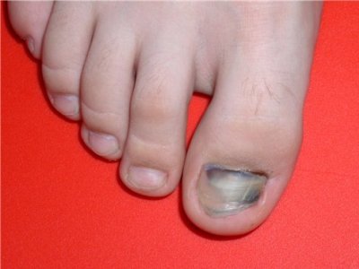 Лечение сбитого ногтя на ноге thumbnail