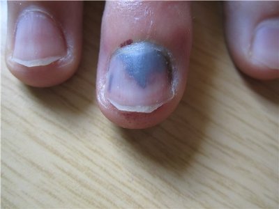 Ушиб ногтя на руке: симптомы, первая помощь, лечение thumbnail