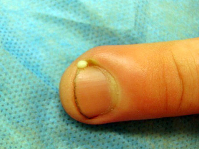 Как вылечить палец после заусенца thumbnail
