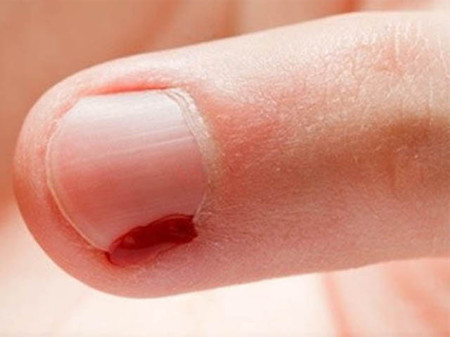 Опух палец на руке возле ногтя от заусенцев thumbnail