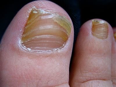 Вид грибка на ногте ноги