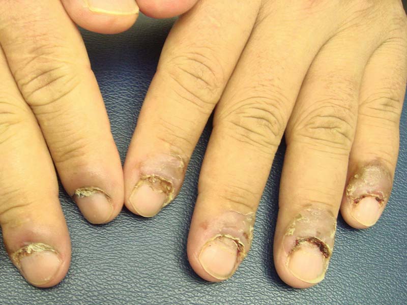 Болезни ногтей являются 