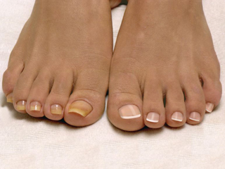 Грибок ногтей очень распространенное заболевание