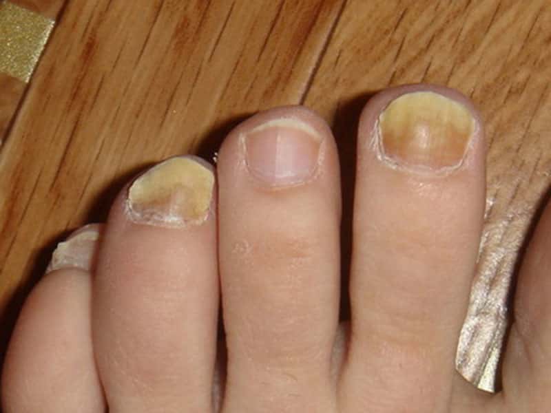 Бактериальное заболевание ногтей на ногах