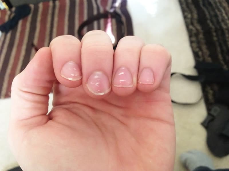 Белые пятна на ногтях рук как симптом неблагополучия организма