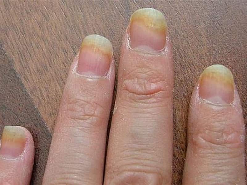 Самостоятельное лечение грибка ногтей медным купоросом
