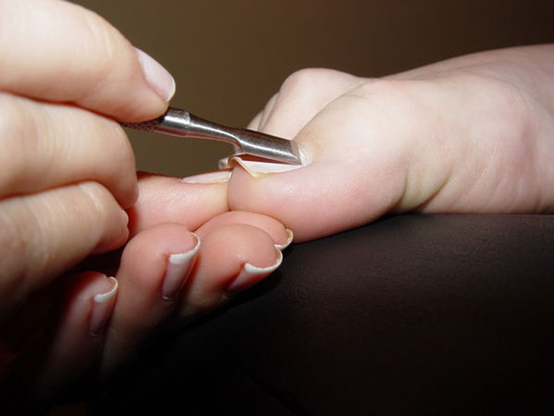 Удаление ногтя на ноге или руке химическим способом