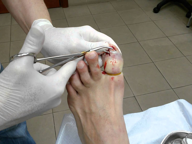 Лечение после удаления ногтя из-за онихомикоза